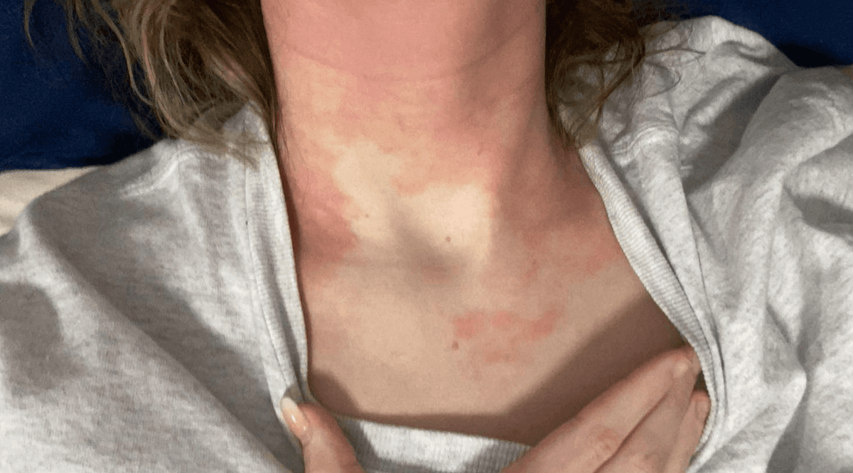What actually is eczema and why does it happen?