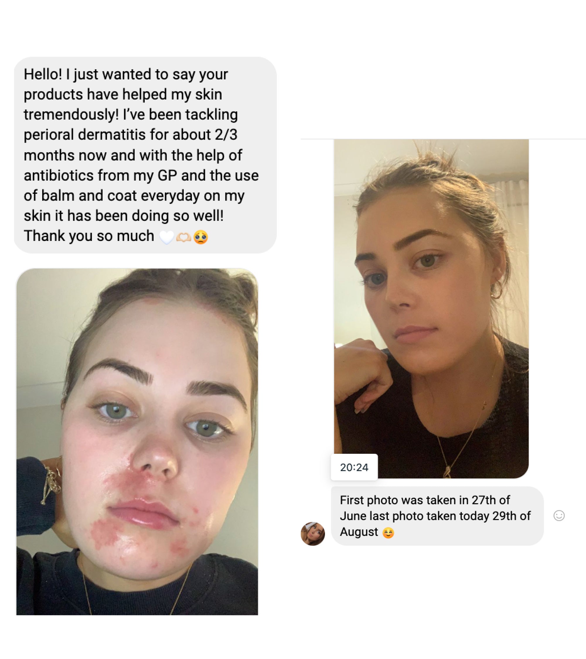 Customer before and after using coat moisturiser 1L for perioral dermatitis
