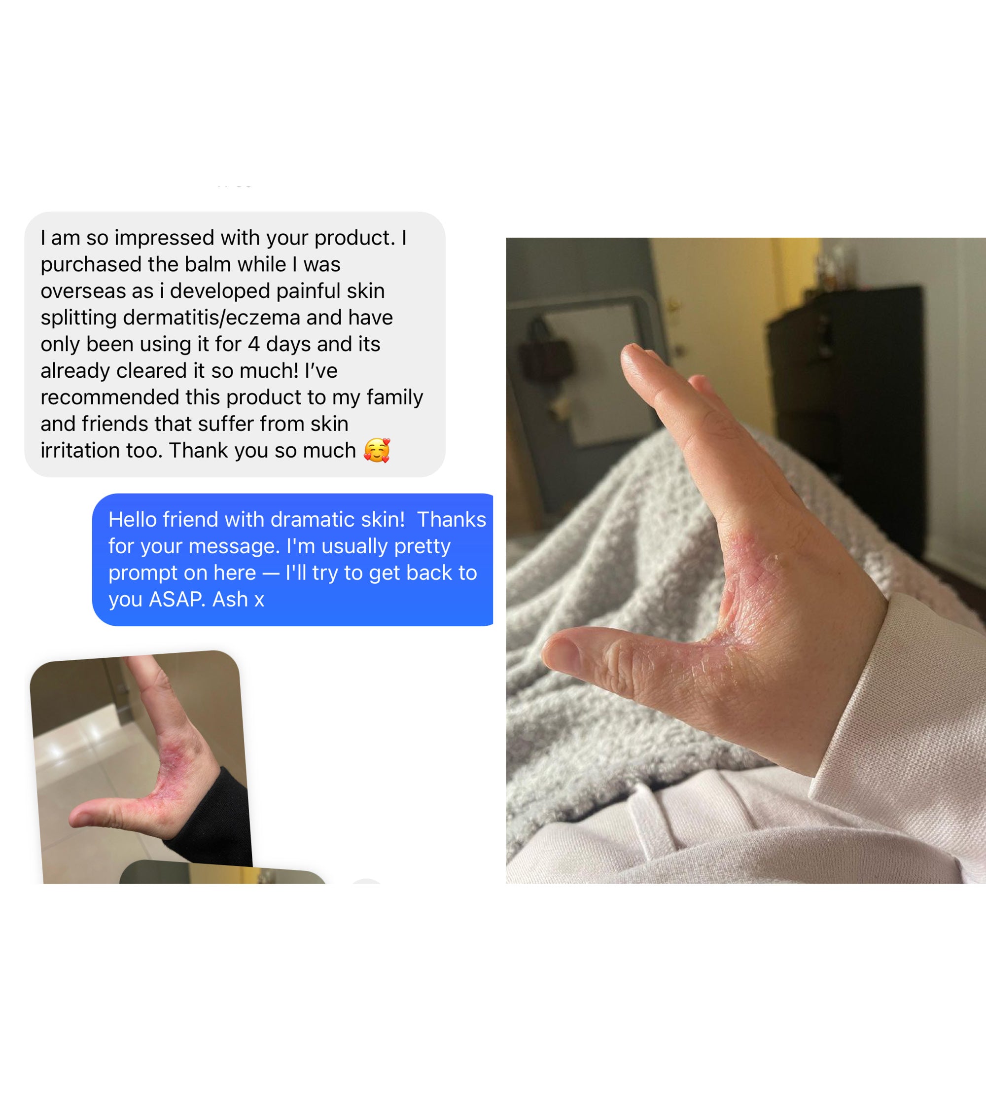 Customer review showing a hand with eczema before and after using 2 x balm 100g