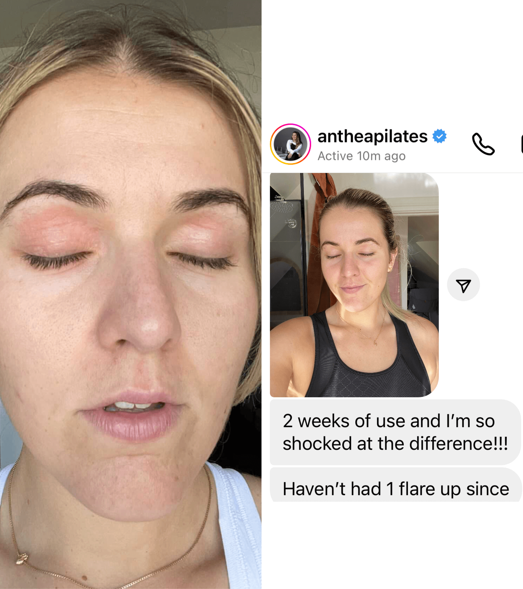 Close-up of a person's face with visible skin condition and a social media post from 'antheapilates' about product use.