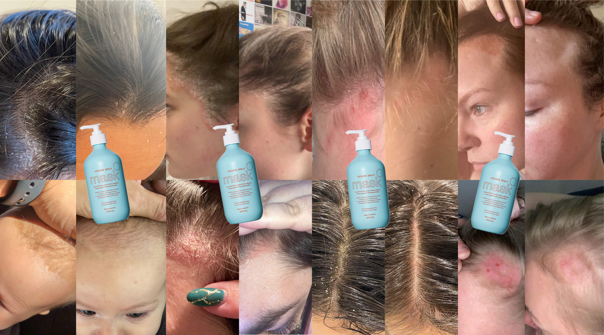 Collage of before and after images showing skin and scalp conditions improved by Yours Only Mask