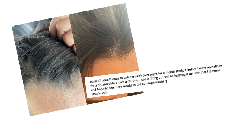 Close up of a person's scalp with dark hair, showing visible flakes before treatment