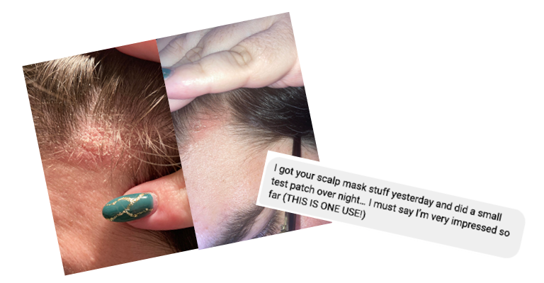 Before and after images of a scalp with a skin condition, showing improvement after one use of scalp mask