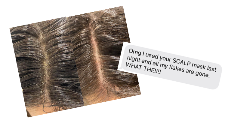 Before and after image of a scalp with flakes, then a clean scalp, with a text message overlay