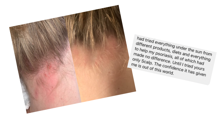 Before and after comparison of a person's scalp with psoriasis and after treatment