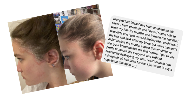 Before and after images of a person's scalp with psoriasis, showing significant improvement