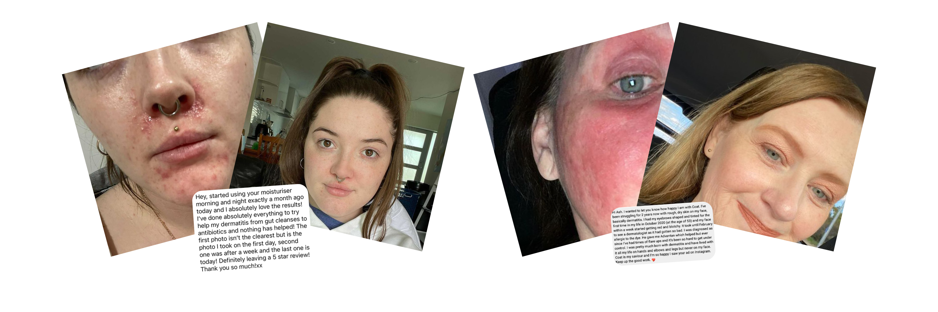 Before and after images of two women with skin conditions, showing improvement after using a product