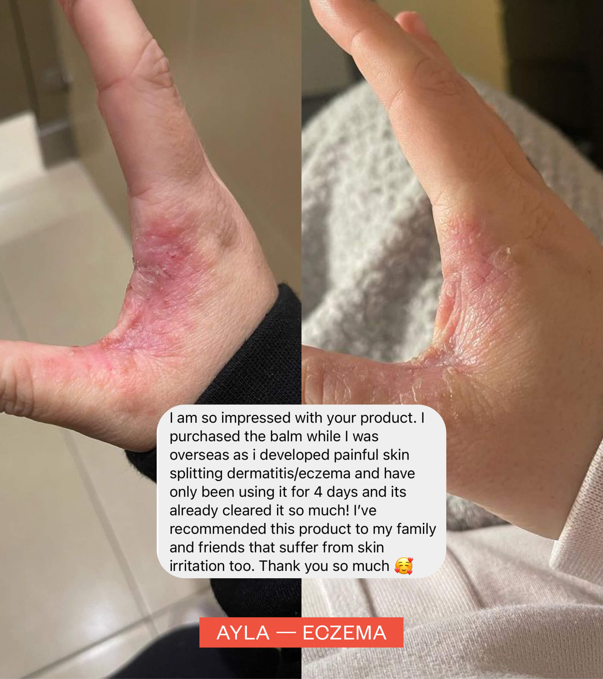 Before and after images of a hand with eczema, showing significant improvement after using clean + coat 100mL bundle