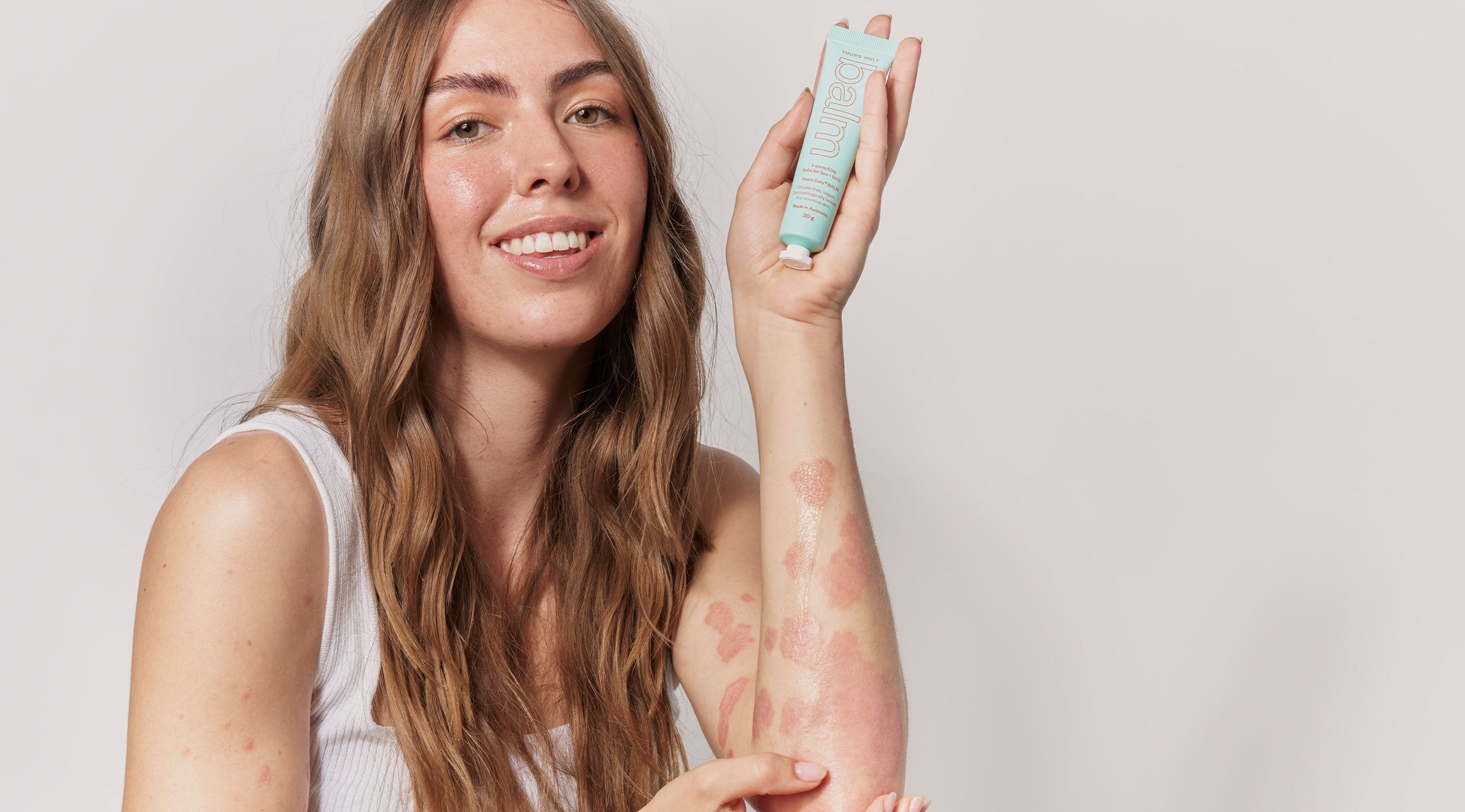 Bree — everchanging psoriasis.