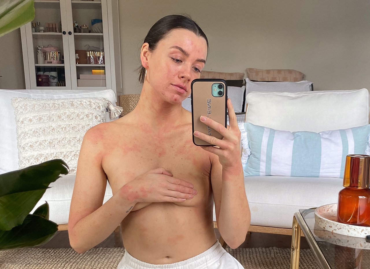 Maddie – eczema