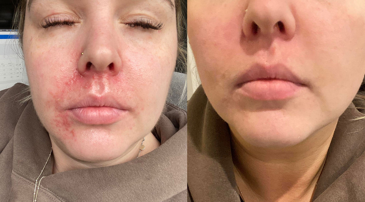 Psh Rash Tips to kick perioral redness to the curb.