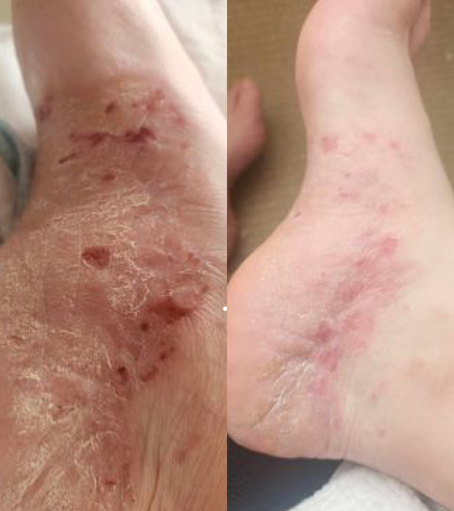 dry feet + heel bundle